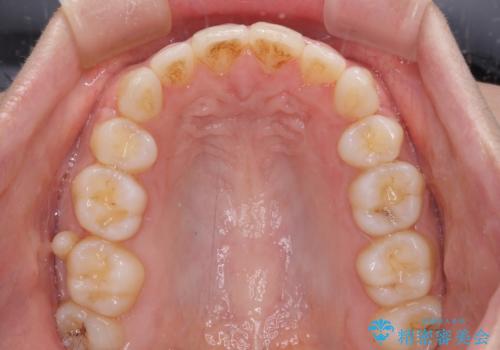 口元をスッキリと ワイヤー装置による抜歯矯正の治療後