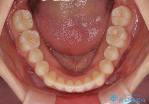 前歯のクロスバイト インビザラインによる矯正治療の治療中