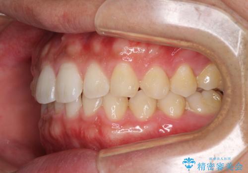 細かい隙間にものがはさまる インビザラインによる矯正治療の治療中