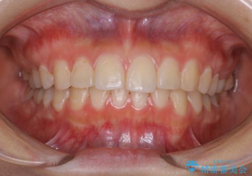 虫歯の治療が終了後にPMTCで全体を綺麗にの治療後