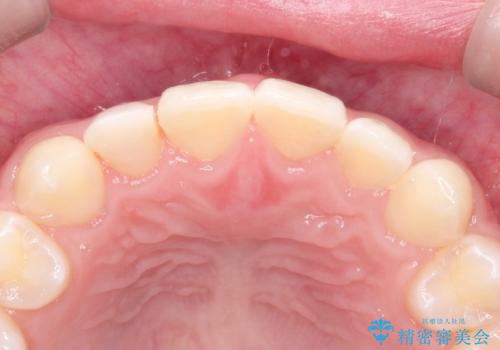 マウスピース矯正とセラミックの組み合わせ治療の治療中