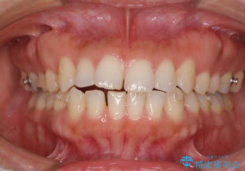 受け口傾向の前歯 すきっ歯の改善の治療中