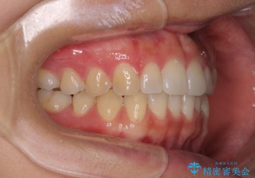 インプラントによる補綴治療とインビザライン矯正の治療後