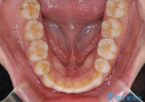 口元をスッキリと　ワイヤー装置による抜歯矯正の治療後