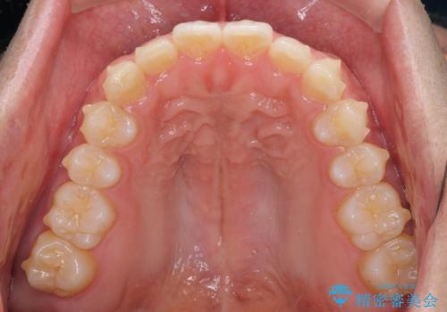 細かい隙間にものがはさまる インビザラインによる矯正治療の治療中