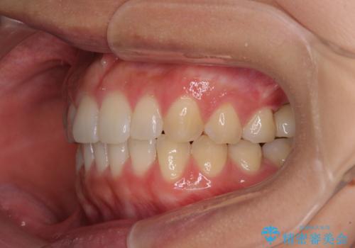 インプラントによる補綴治療とインビザライン矯正の治療後