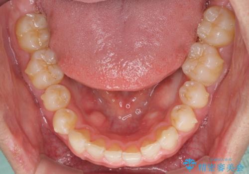 細かい隙間にものがはさまる インビザラインによる矯正治療の治療中