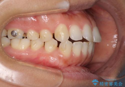 受け口傾向の前歯　すきっ歯の改善の治療中