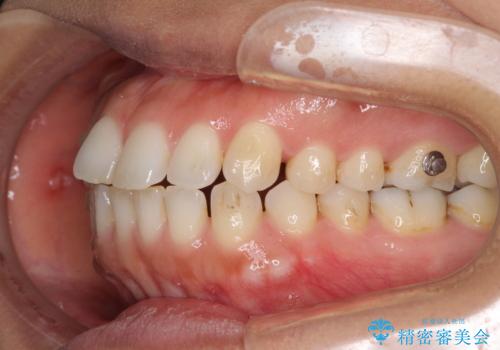 受け口傾向の前歯　すきっ歯の改善の治療中