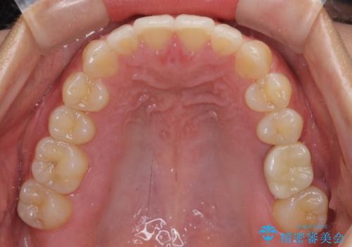 インプラントによる補綴治療とインビザライン矯正の治療後