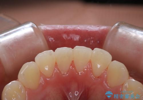虫歯の治療が終了後にPMTCで全体を綺麗にの治療後