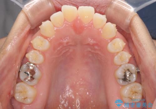 受け口傾向の前歯 すきっ歯の改善の治療中