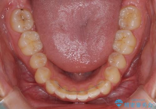 インプラントによる補綴治療とインビザライン矯正の治療後