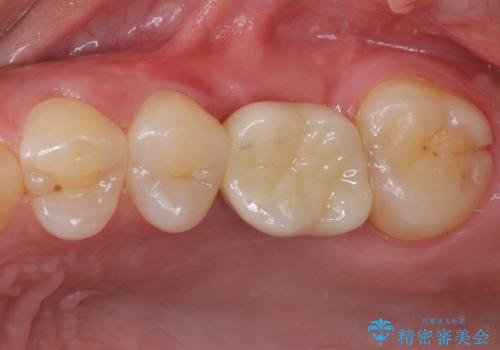 インプラントによる補綴治療とインビザライン矯正の治療後