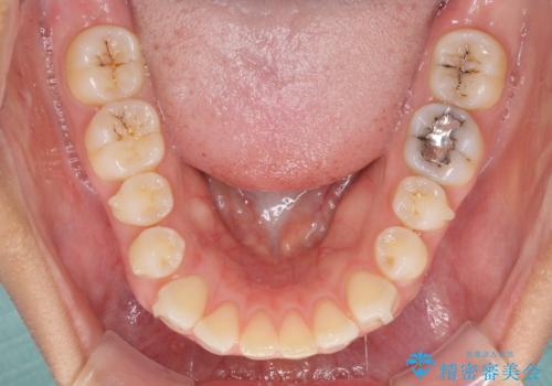 受け口傾向の前歯 すきっ歯の改善の治療中