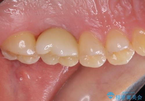 インプラントによる補綴治療とインビザライン矯正の治療後