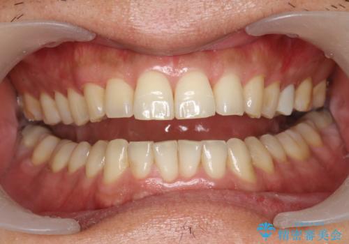 奥歯のセラミックと色を合わせたい オフィスホワイトニングの治療前