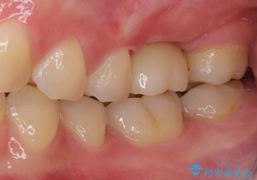 インプラントによる補綴治療とインビザライン矯正の治療後