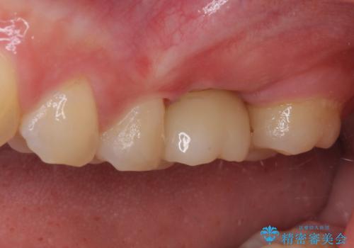 インプラントによる補綴治療とインビザライン矯正の治療後