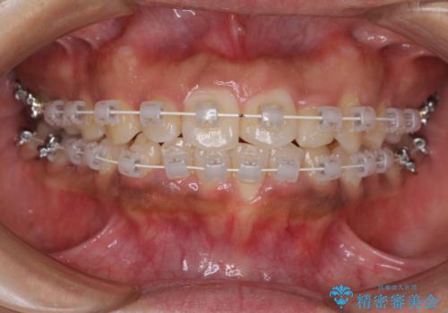 インビザラインが続けられない ワイヤー装置での矯正治療の治療中