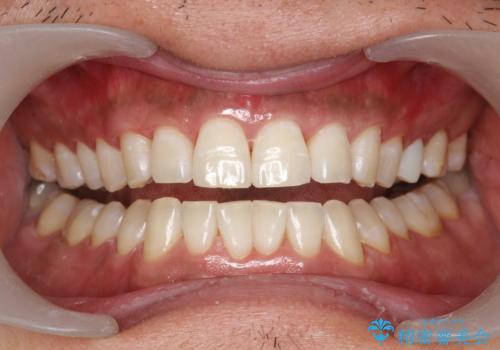 奥歯のセラミックと色を合わせたい オフィスホワイトニングの治療後
