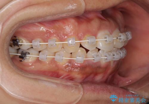 インビザラインが続けられない ワイヤー装置での矯正治療の治療中