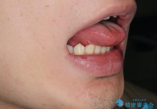 [舌小帯形成術]  滑舌が悪いと言われるの治療後