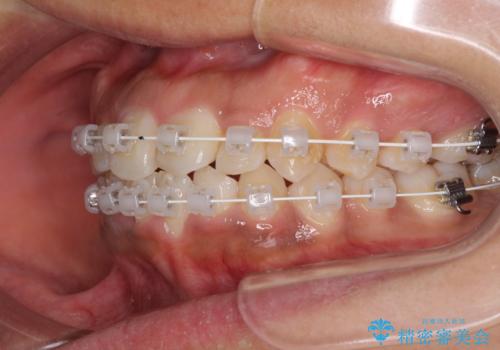 インビザラインが続けられない ワイヤー装置での矯正治療の治療中