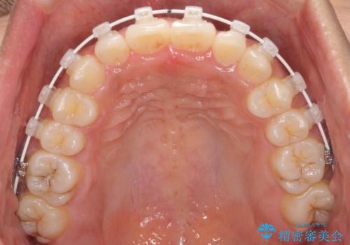 インビザラインが続けられない ワイヤー装置での矯正治療の治療中