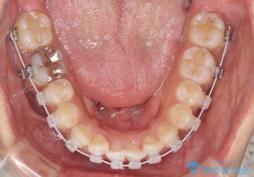 インビザラインが続けられない ワイヤー装置での矯正治療の治療中