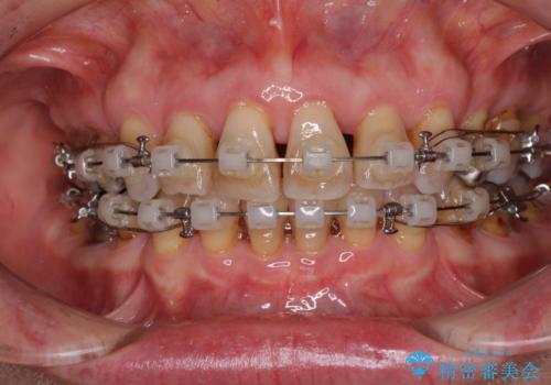 出っ歯を改善した後に真っ白な歯に 矯正歯科治療と審美歯科治療の治療中
