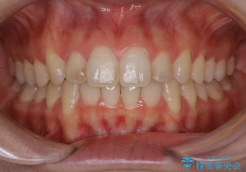 前歯の着色をPMTCできれいにの治療前
