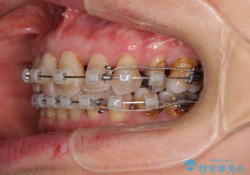 出っ歯を改善した後に真っ白な歯に　矯正歯科治療と審美歯科治療の治療中