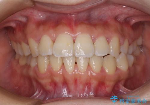 軽微な歯列不正をワイヤー矯正で整えるの症例 治療後