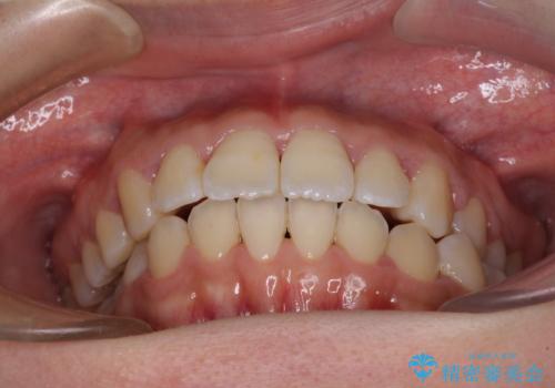 軽微な歯列不正をワイヤー矯正で整えるの治療後