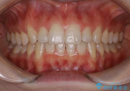 前歯の着色をPMTCできれいにの治療後