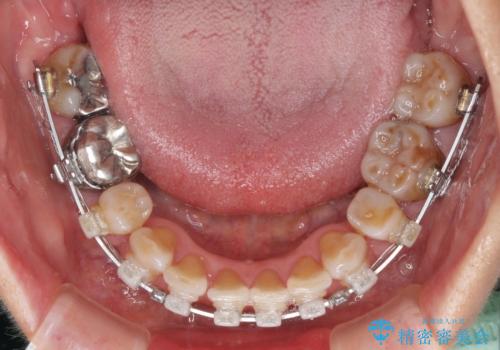 出っ歯を改善した後に真っ白な歯に　矯正歯科治療と審美歯科治療の治療中