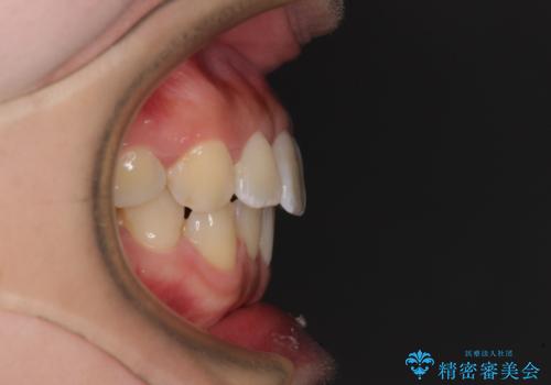 軽微な歯列不正をワイヤー矯正で整えるの治療後