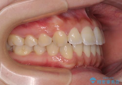 軽微な歯列不正をワイヤー矯正で整えるの治療後