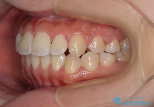 軽微な歯列不正をワイヤー矯正で整えるの治療後