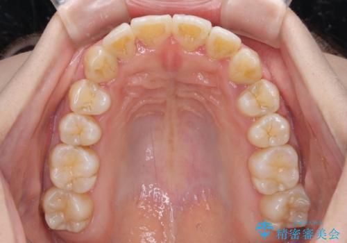 軽微な歯列不正をワイヤー矯正で整えるの治療後