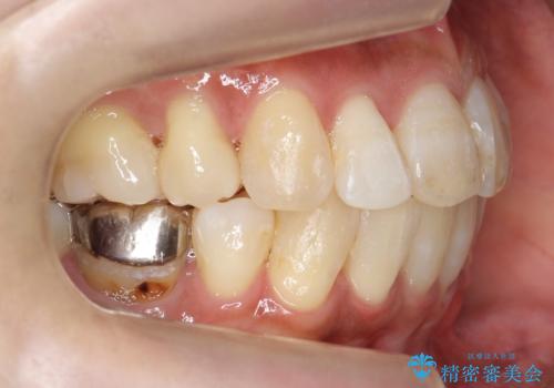 出っ歯　前歯のがたがた　口元を引っ込めたいの治療後