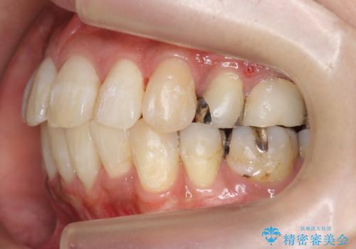 出っ歯　前歯のがたがた　口元を引っ込めたいの治療後