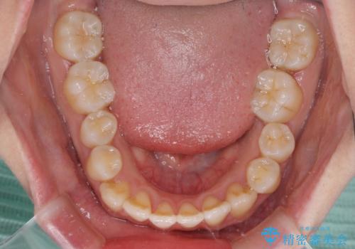 軽微な歯列不正をワイヤー矯正で整えるの治療後