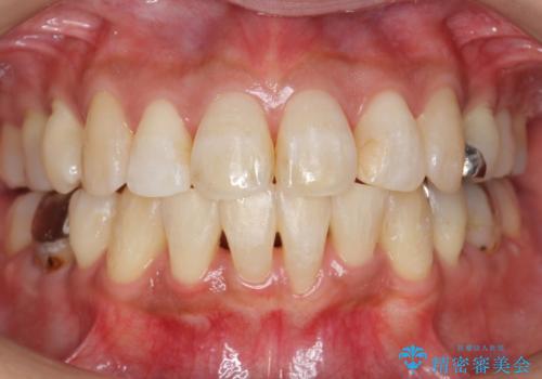 出っ歯 前歯のがたがた 口元を引っ込めたいの症例 治療後