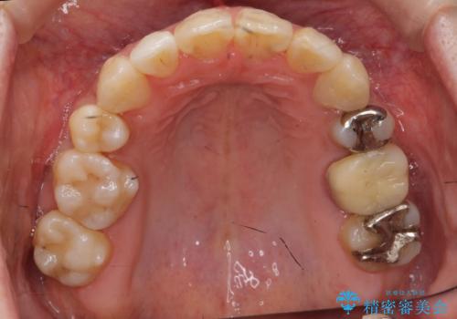 出っ歯 前歯のがたがた 口元を引っ込めたいの治療後