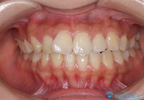 軽微な歯列不正をワイヤー矯正で整えるの治療前