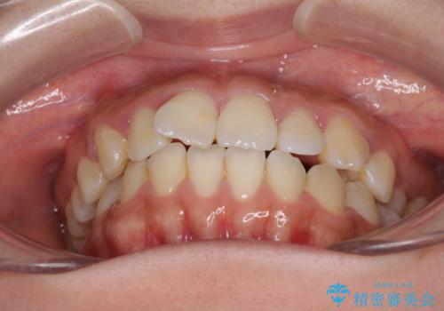 軽微な歯列不正をワイヤー矯正で整えるの治療前