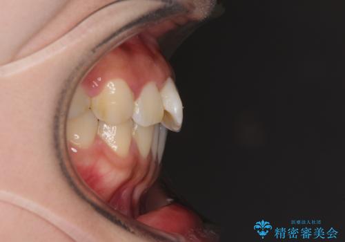 軽微な歯列不正をワイヤー矯正で整えるの治療前