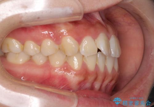 軽微な歯列不正をワイヤー矯正で整えるの治療前